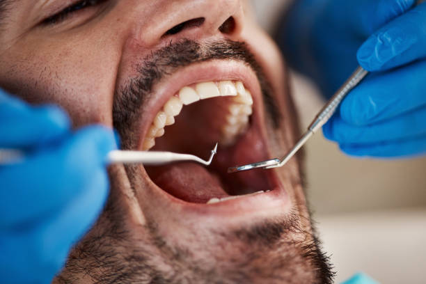 Best Emergency Tooth Extraction in Burnet, TX